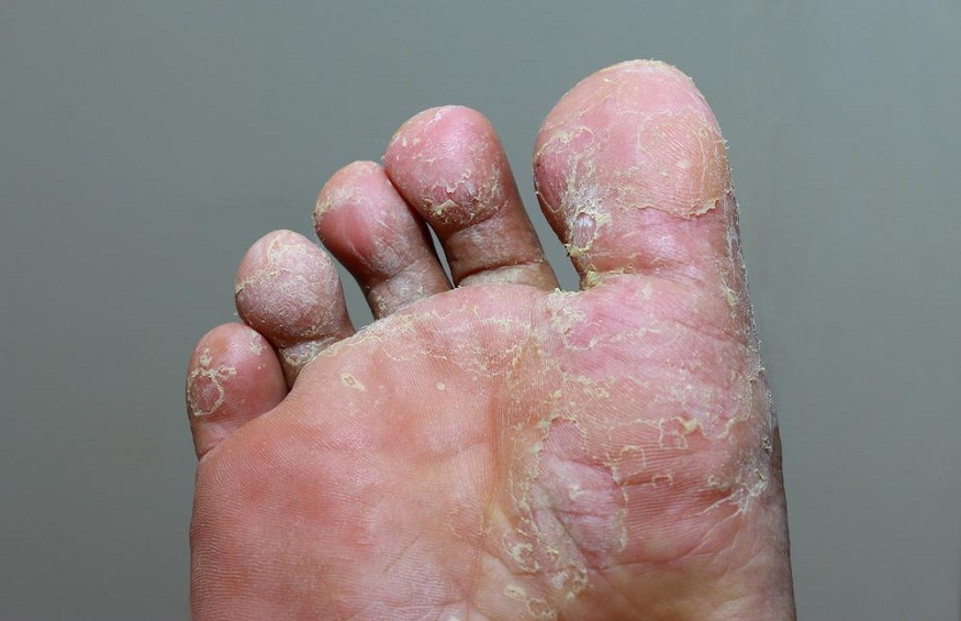 5 Ways to Protect Yourself from Fungal Infections